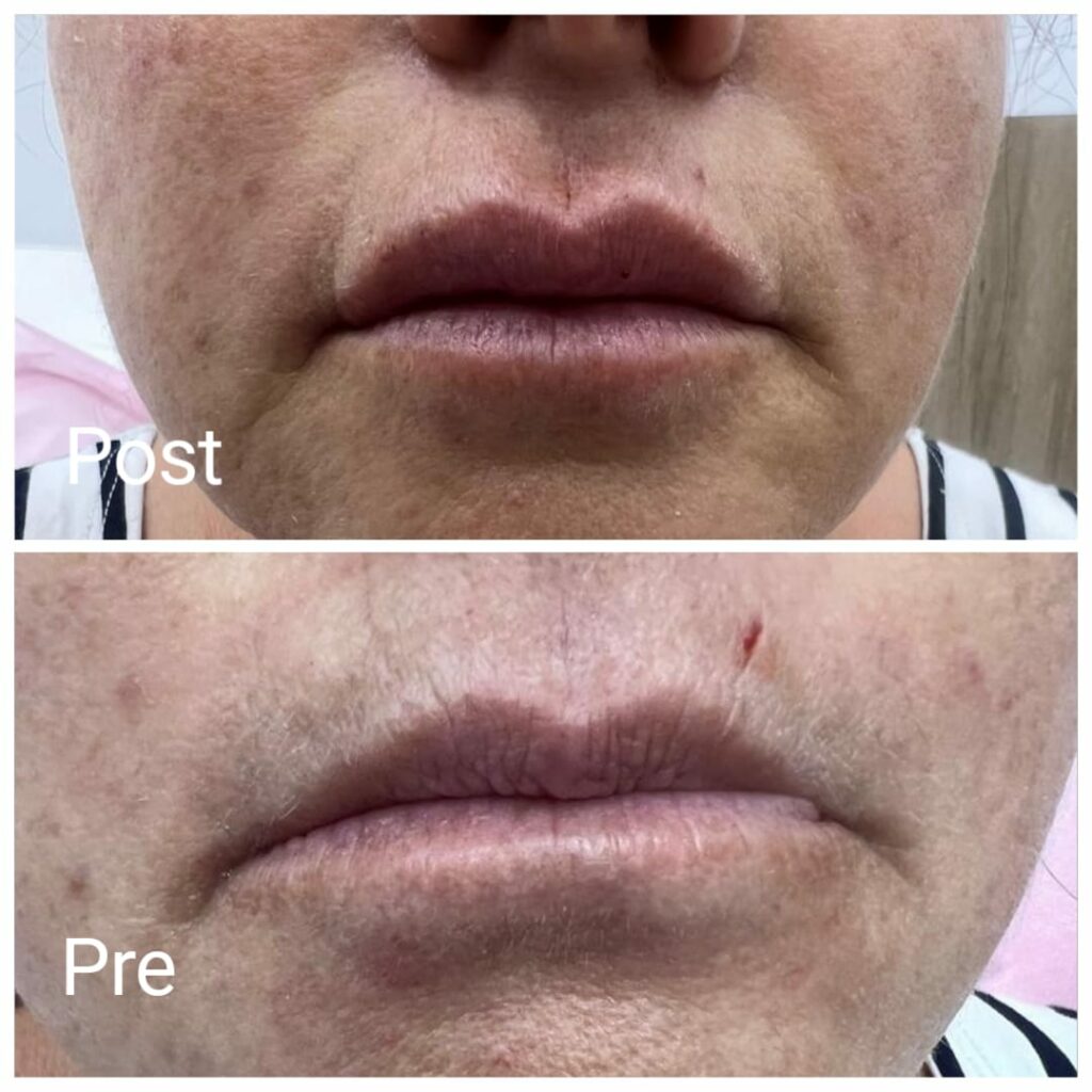 Lip filler injection before and after
